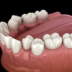 Crowded set of teeth