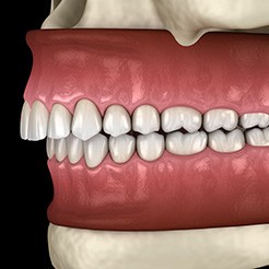 Image of an overbite