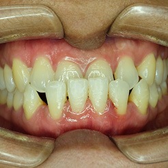 Image of a patient’s underbite