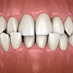 Crossbite with teeth overlapping
