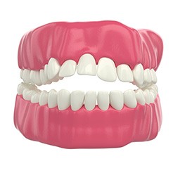 Front upper and lower teeth not touching